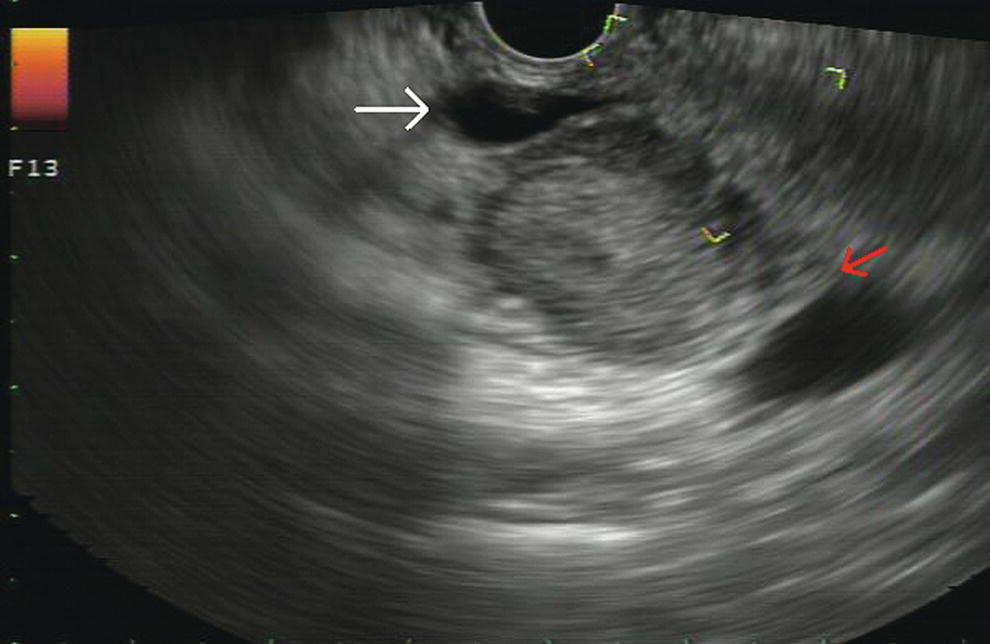 Photo depicts a 2-cm pancreatic head mass seen to abut and compress the common bile duct (white arrow, top of image) and to abut the portal vein (bottom of image) with an intact tissue plane between the mass and the vessel (red arrow).