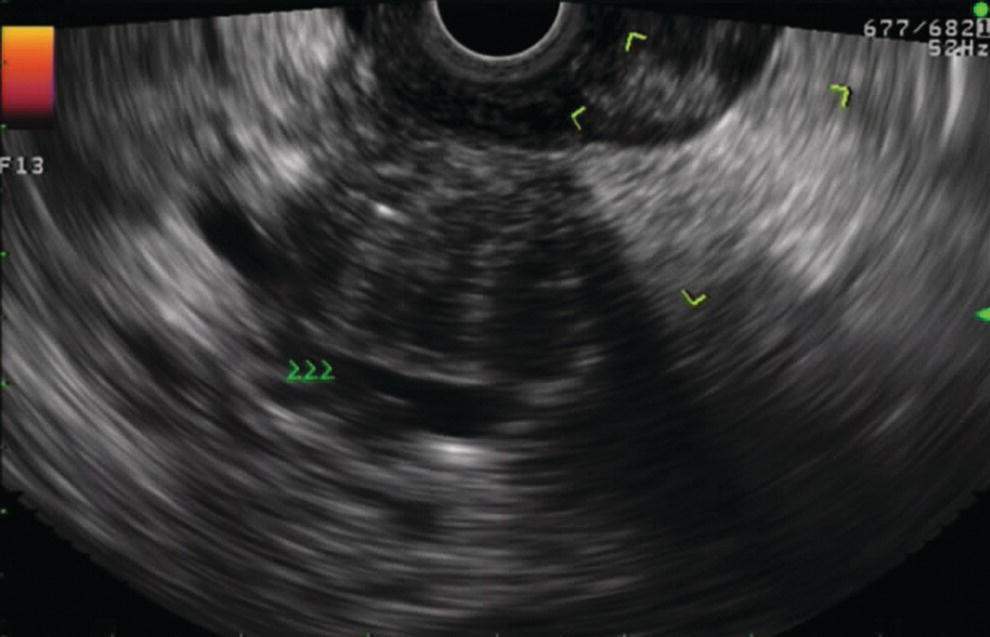 Photo depicts large pancreatic cancer in the head of the pancreas seen to encase the superior mesenteric vein.