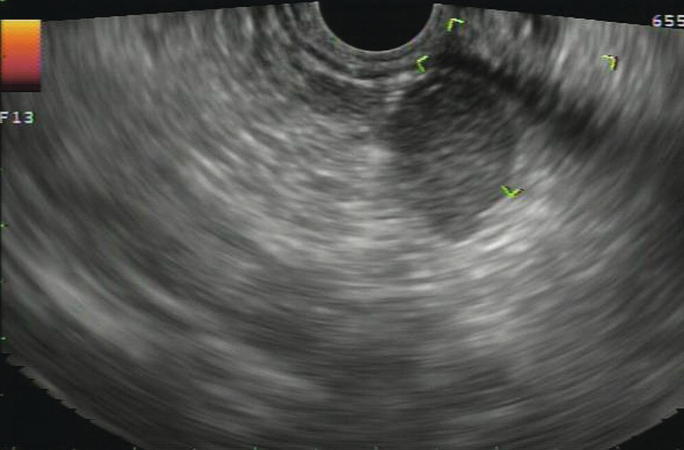 Photo depicts a 15-mm peripancreatic lymph node.