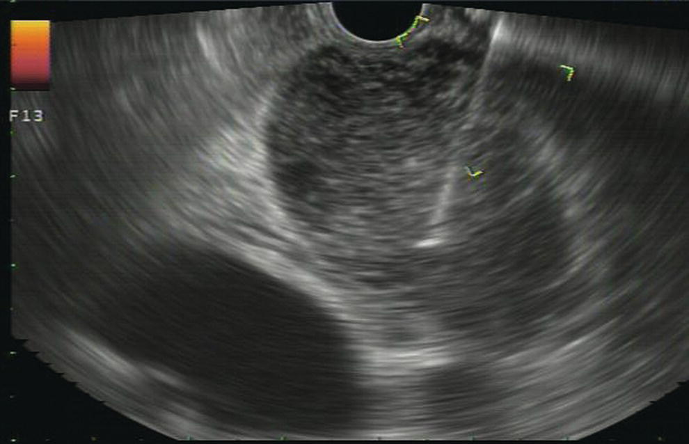 Photo depicts EUS-guided FNA of a large, 4-cm peripancreatic node in a patient with pancreatic adenocarcinoma.