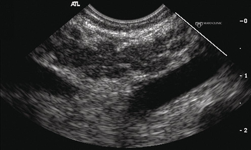Photo depicts almost classic endoscopic ultrasound appearance of autoimmune pancreatitis with a hypoechoic gland and coarse, patchy, heterogeneous changes without glandular enlargement.