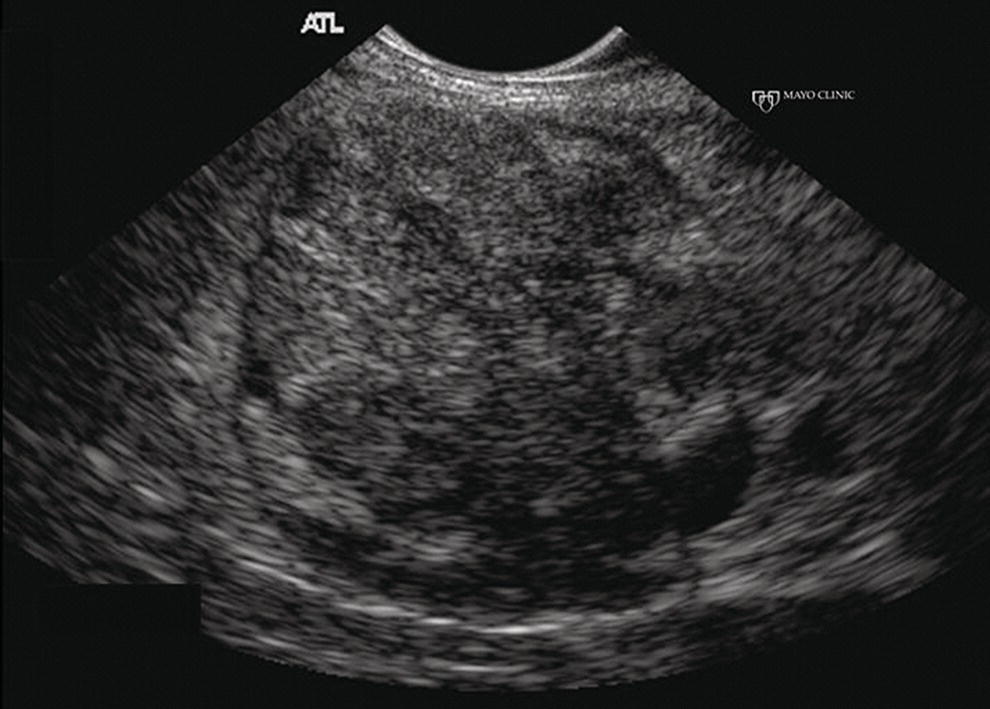 Photo depicts endoscopic ultrasound finding of a mass-like lesion in a patient with autoimmune pancreatitis that may be confused with an unresectable pancreatic ductal carcinoma.
