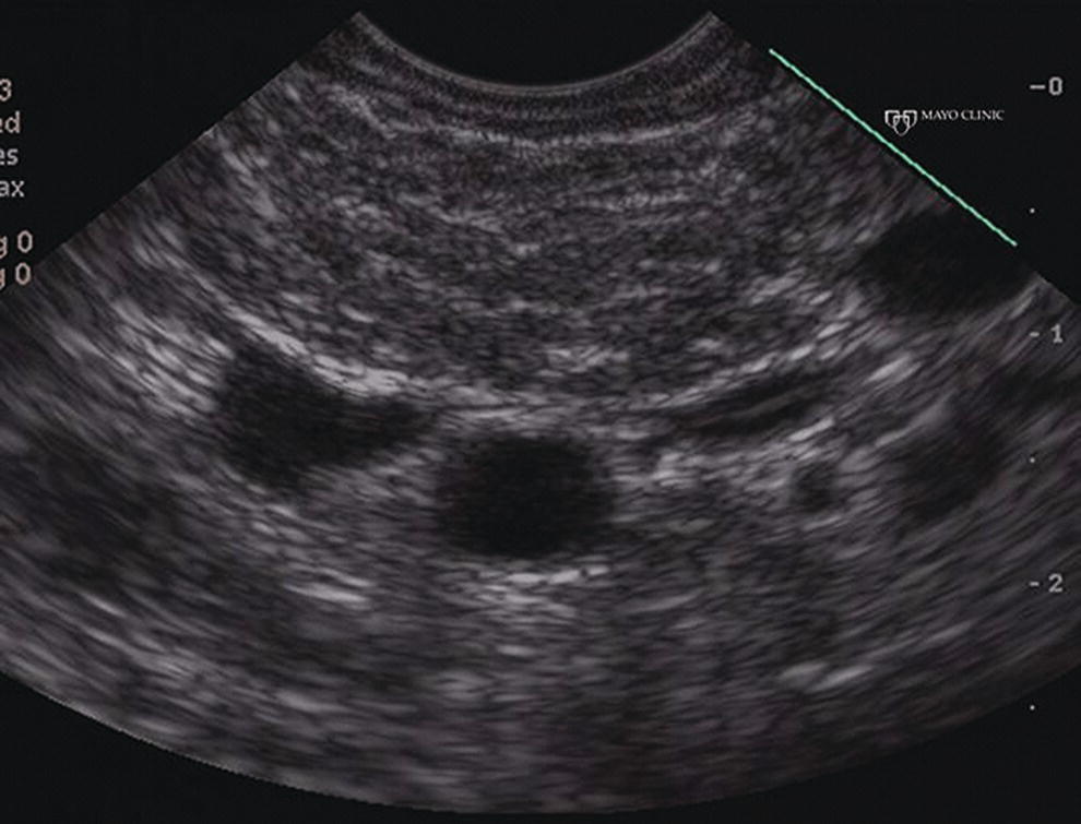 Photo depicts endoscopic ultrasound features of nonspecific chronic pancreatitis in a patient with autoimmune pancreatitis.