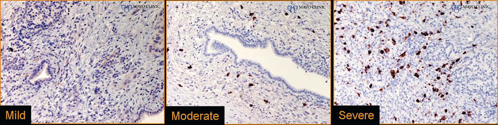 Photo depicts IgG4 immunostaining of the Tru-cut biopsy specimen reveals the findings of mild infiltration and severe infiltration.