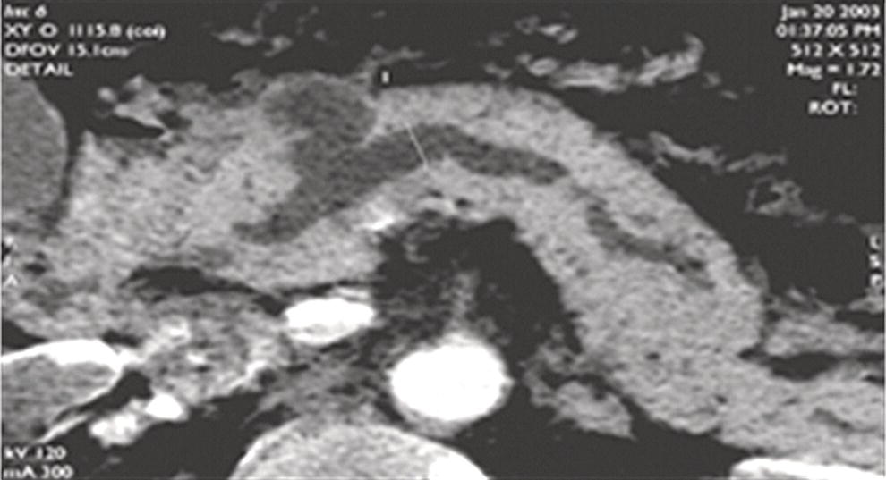 Photo depicts reformatted computed tomography scan demonstrating a side-branch intraductal papillary mucinous neoplasm.