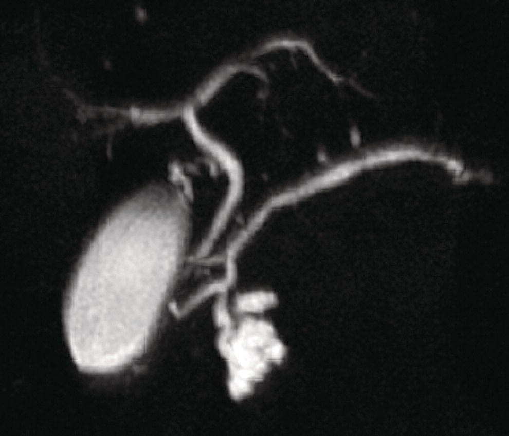 Photo depicts magnetic resonance cholangiopancreatography demonstrating a side-branch intraductal papillary mucinous neoplasm in the head of the pancreas.
