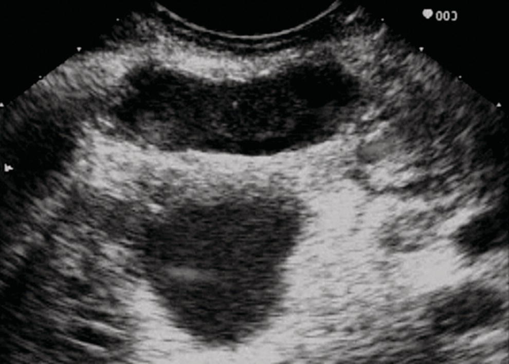 Photo depicts linear endoscopic ultrasound image demonstrating a dilated main pancreatic duct, indicative of a main-duct intraductal papillary mucinous neoplasm.