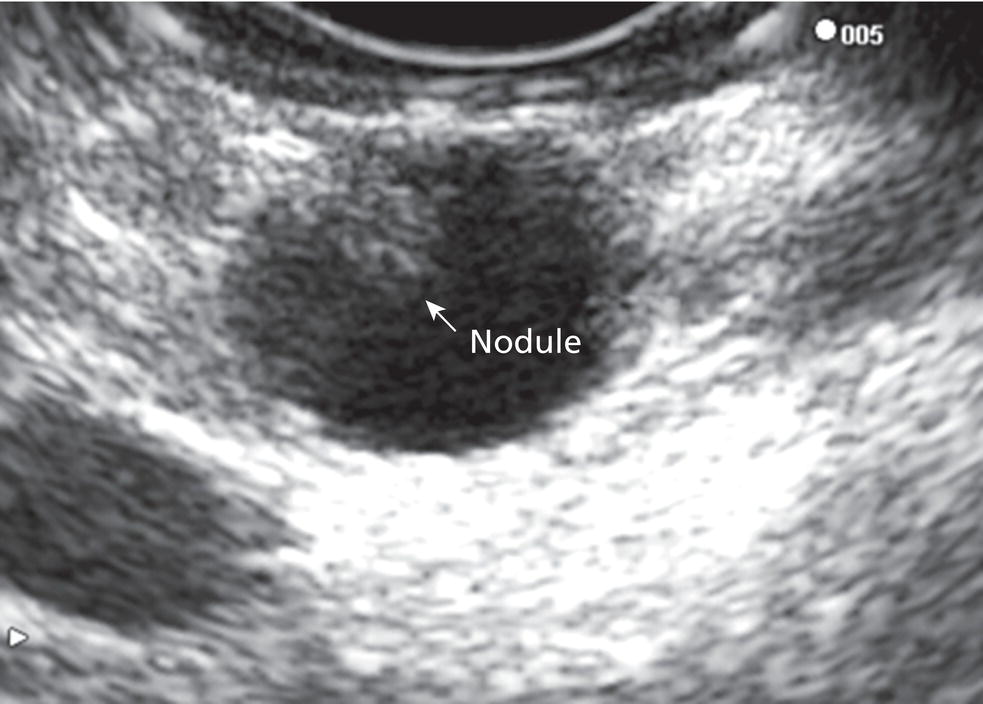 Photo depicts linear endoscopic ultrasound image revealing a small cystic lesion with a mural nodule.