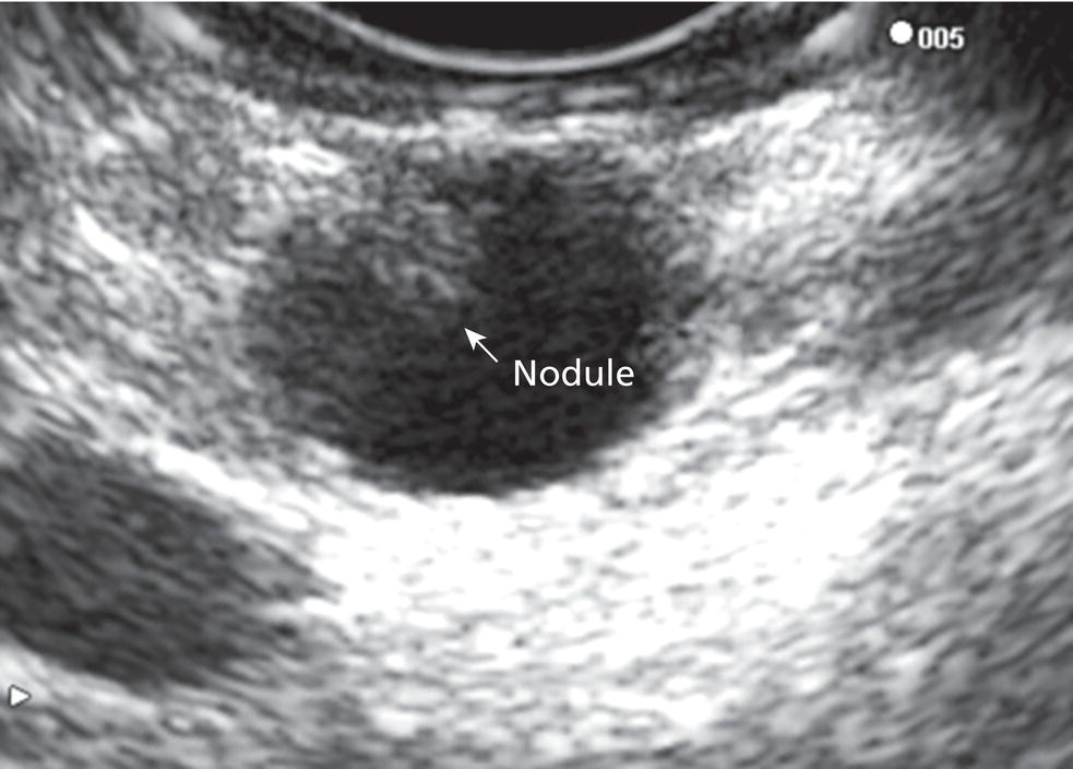 Intraductal Papillary Mucinous Neoplasms | Radiology Key