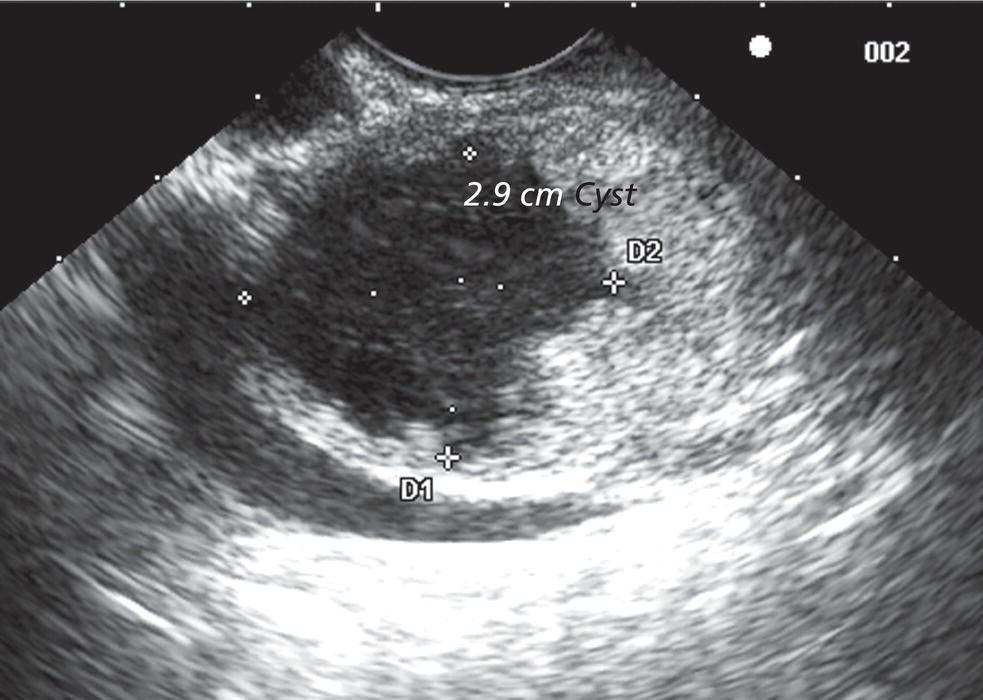 Photo depicts linear endoscopic ultrasound image of a malignant-appearing 2.9-cm cystic lesion, including an adjacent mass.
