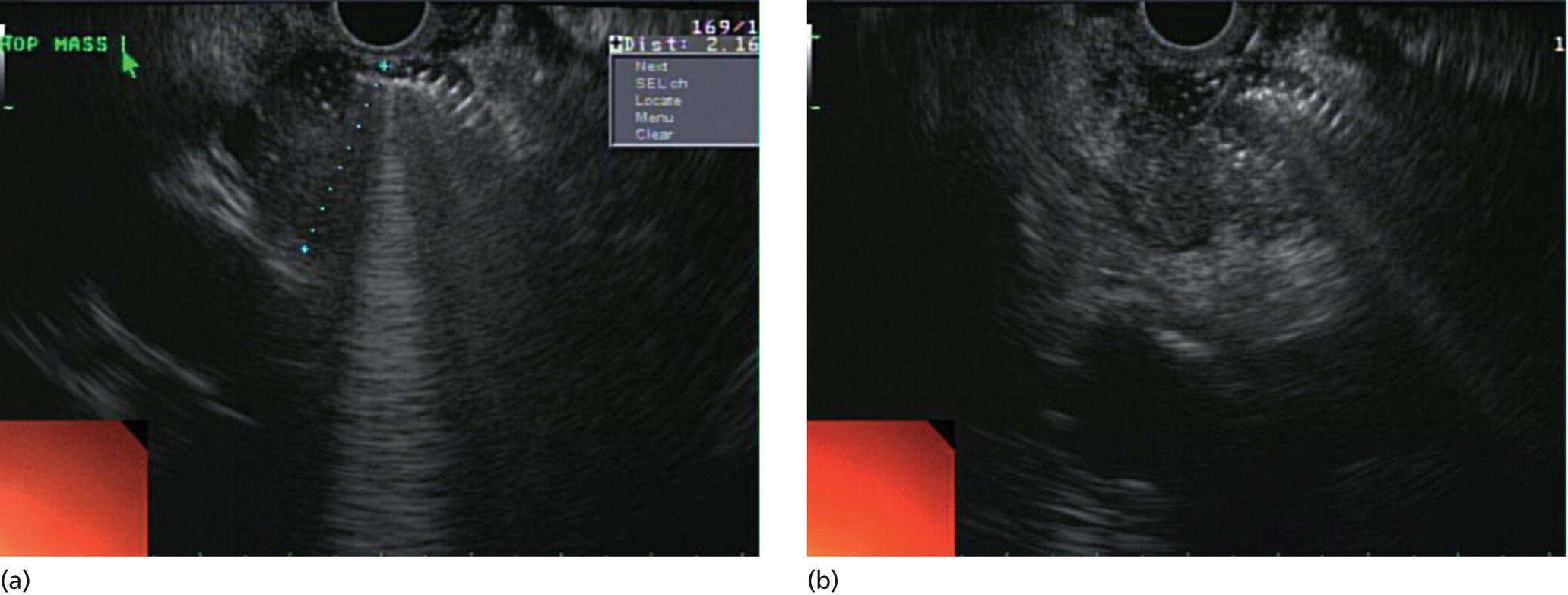 Photos depict (a) A 2-cm mass in the head of pancreas with acoustic interference from a metal stent within the common bile duct. (b) Fine needle aspiration through the metal stent to sample tissue from the inferior portion of the mass.