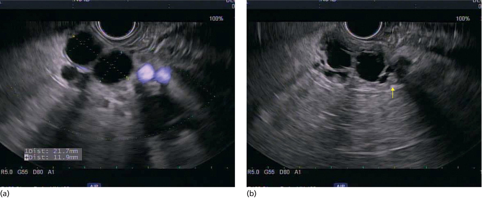 Photos depict (a) EUS of anechoic septated lobular cyst in tail of pancreas. (b) EUS of anechoic septated lobular pancreatic cyst with nodule (yellow arrow) proven malignant on surgical resection.