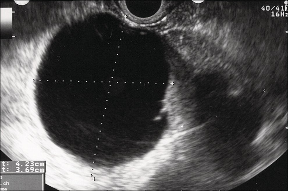 Photo depicts a large unilocular pseudocyst with clear contents as visualized under EUS guidance.