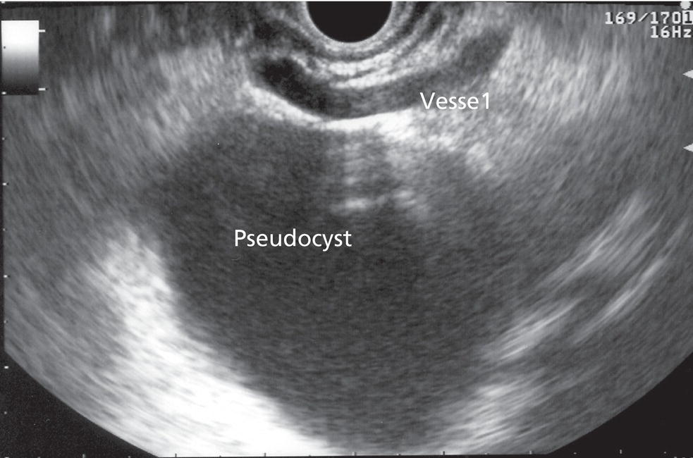 Photo depicts presence of intervening vasculature between the EUS transducer and the pseudocyts.