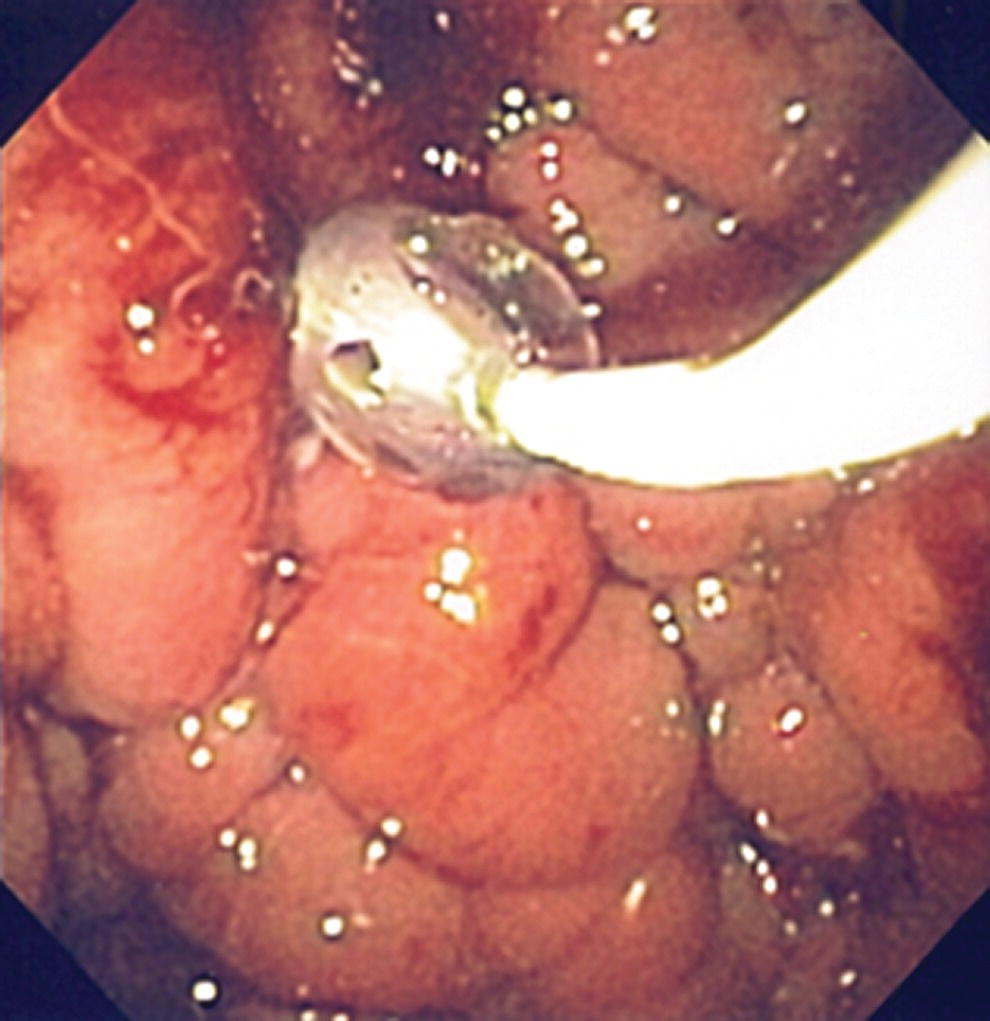 Photo depicts endoscopic ultrasound guidance enables access to the pseudocyst by providing an appropriate window in a patient with gastric varices.