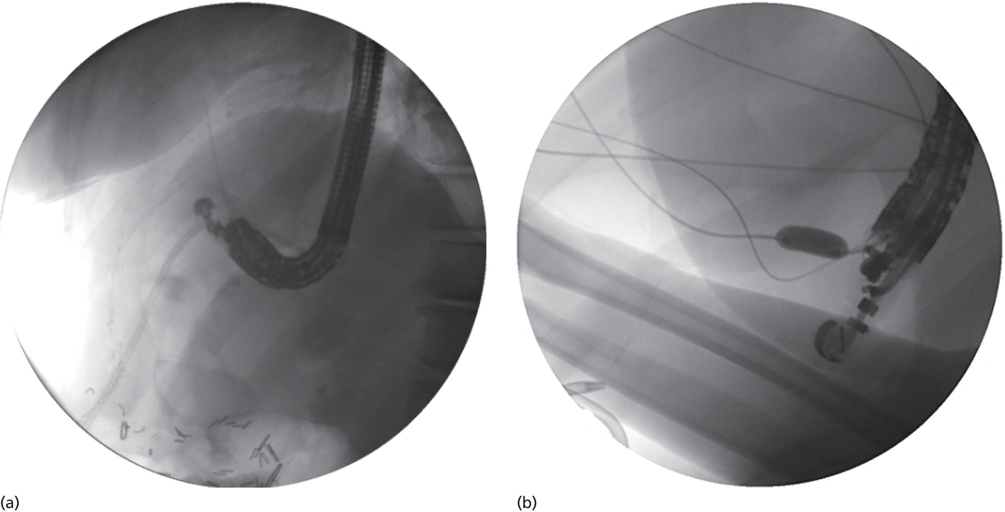 Photos depict (a) Acute angulation encountered when the echoendoscope is located in the gastric fundus. (b) The tip of the echoendoscope is subsequently straightened with aid of fluoroscopy to facilitate passage of accessories.