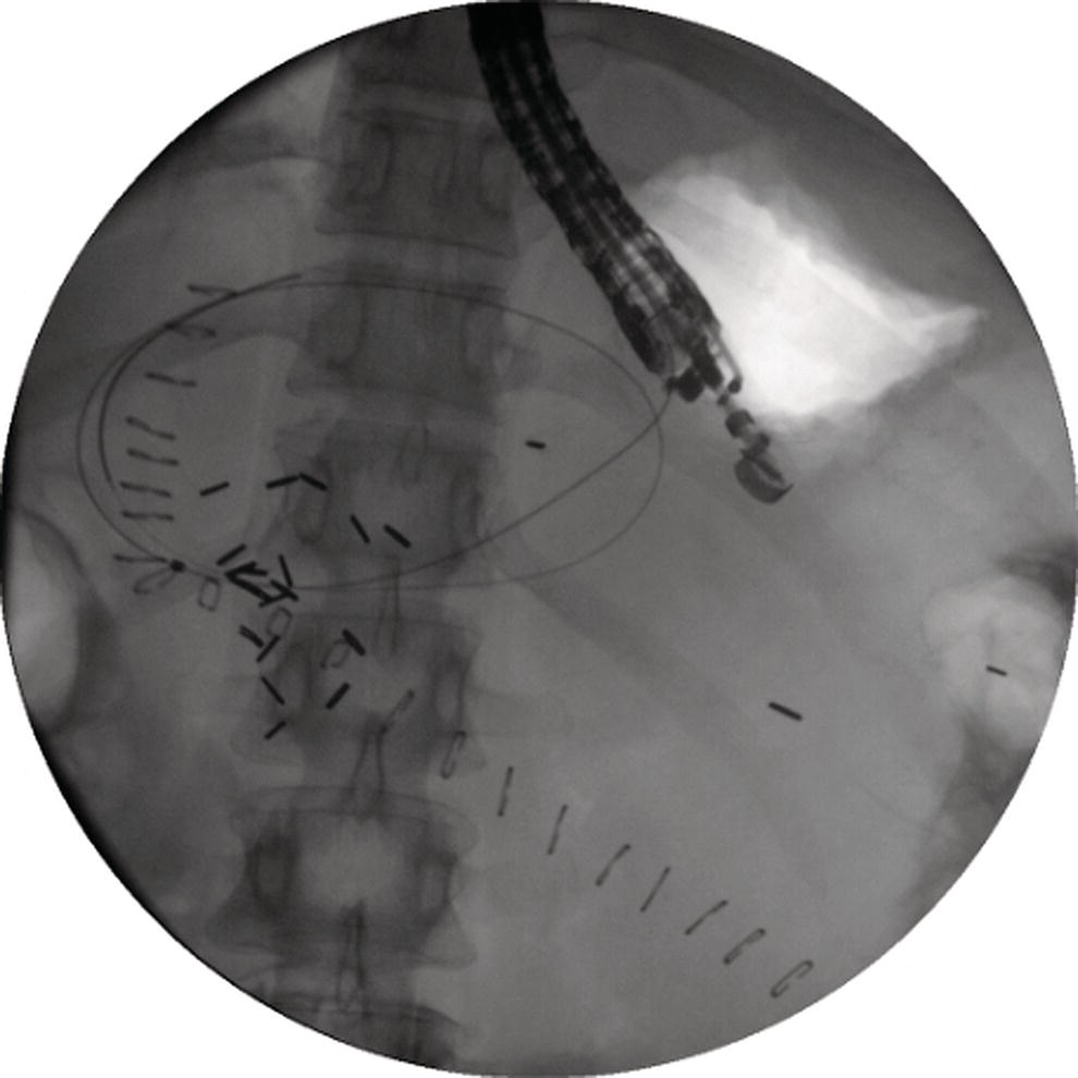 Photo depicts a 0.035-inch guidewire is coiled within the pseudocyst under fluoroscopic guidance.