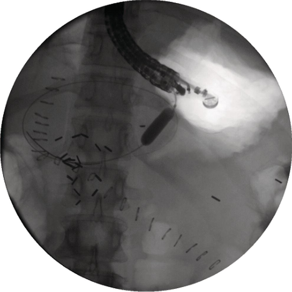 Photo depicts the transmural tract is subsequently dilated using an 8 mm over-the-wire biliary balloon dilator.