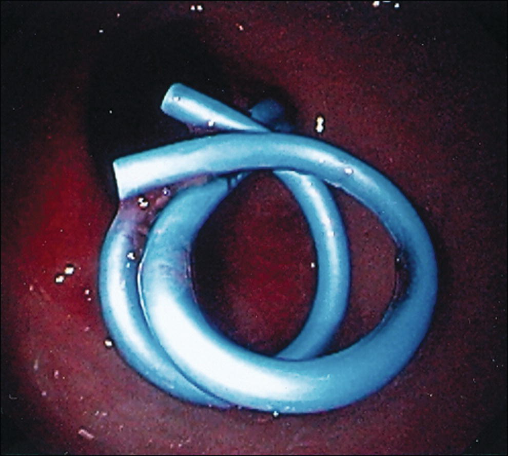Photo depicts multiple 7-Fr transmural stents are deployed (fluoroscopy view) to facilitate drainage of pseudocyst contents.