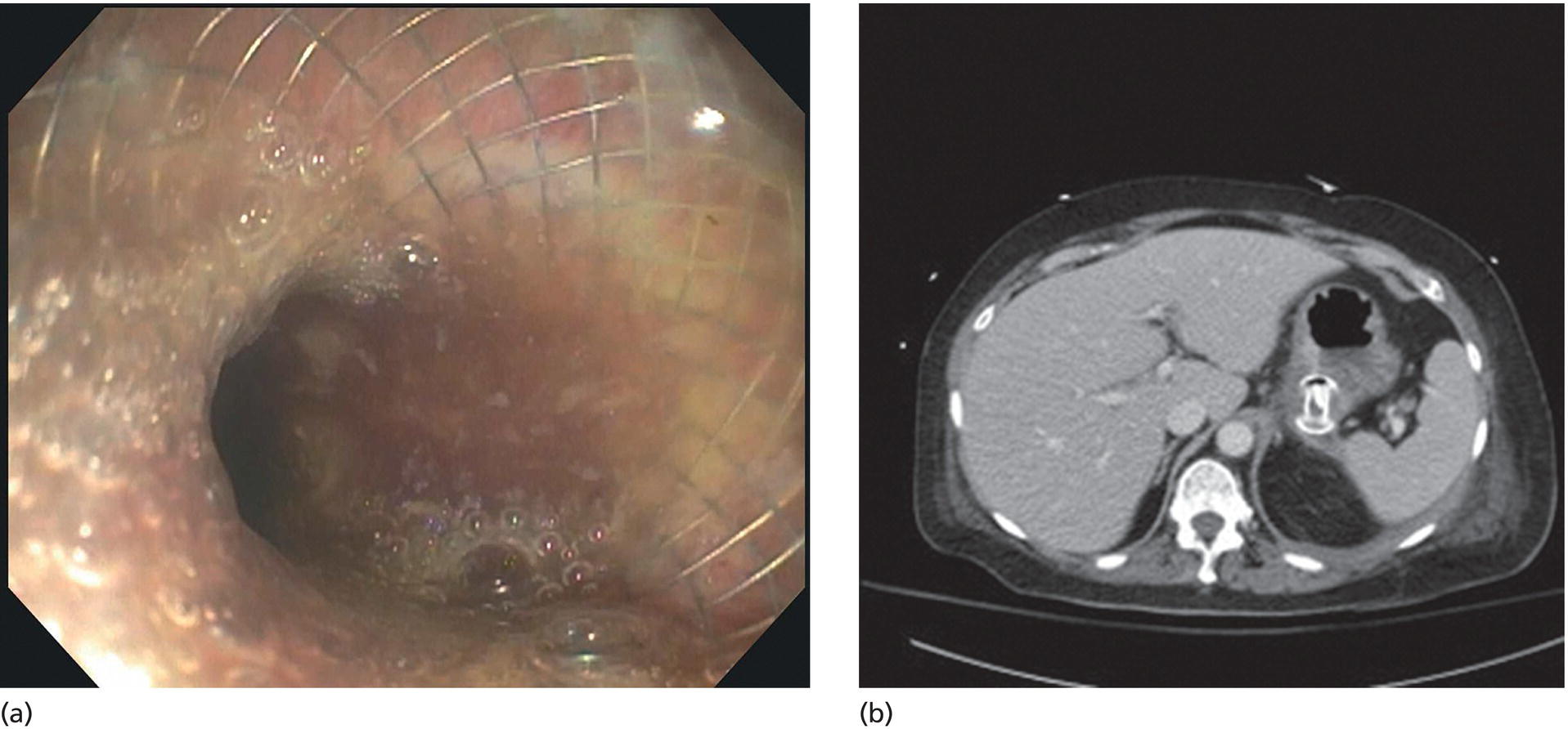 Photos depict (a) Endoscopic view of the proximal flange of the LAMS in the stomach lumen with drainage of cyst contents. (b) CT of the abdomen demonstrating the LAMS placed for drainage of pseudocyst.