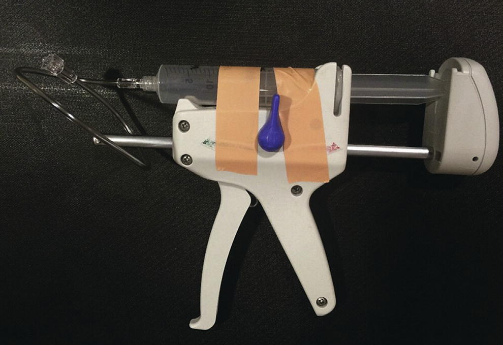 Photo depicts a high-pressure gun, syringe, and short connector tubing assembly which can be used to quickly infuse viscous ablation agents into a cyst after the mucinous fluid is aspirated.