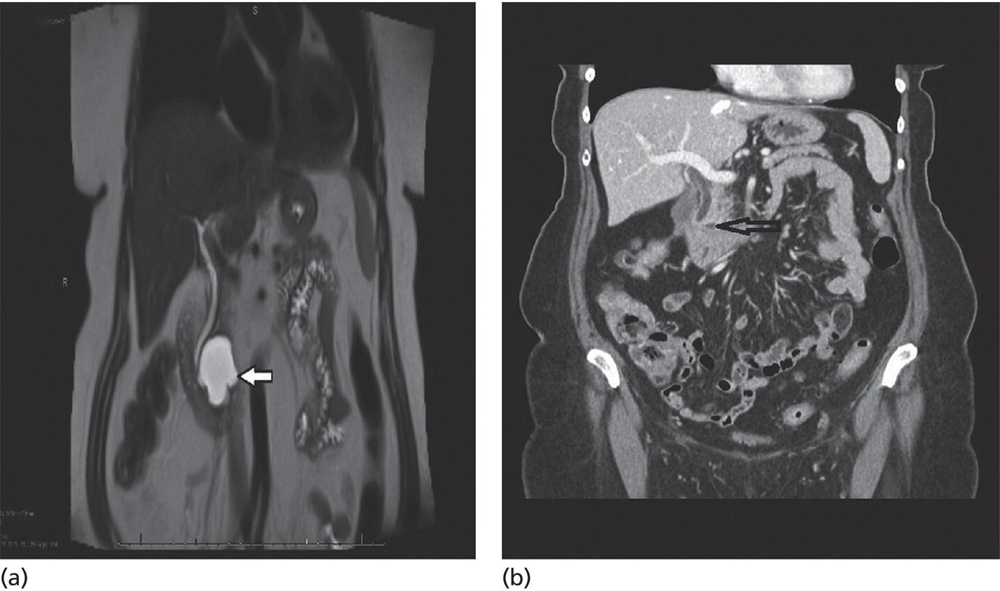 Photos depict (a) Magnetic resonance image showing a 76-year-old female with a 4.2-cm mucinous-type pancreatic cyst before EUS-guided chemoablation. (b) CT image showing a 4-mm residual defect at one year.