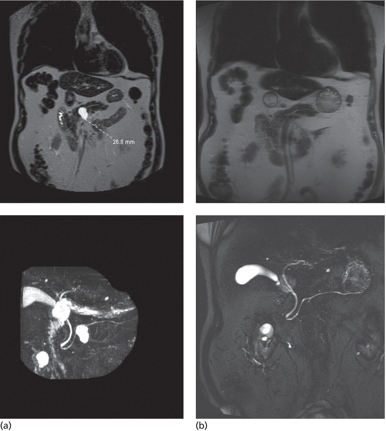 Photos depict (a) MRI (top) and magnetic resonance cholangiopancreatography (bottom) of an 83-year-old male with a 2.7-cm intraductal mucinous pancreatic neoplasm prior to EUS-guided chemoablation. (b) Follow-up MRI (top) and MRCP (bottom) reveals no evidence of residual cyst at six-month follow-up evaluation.
