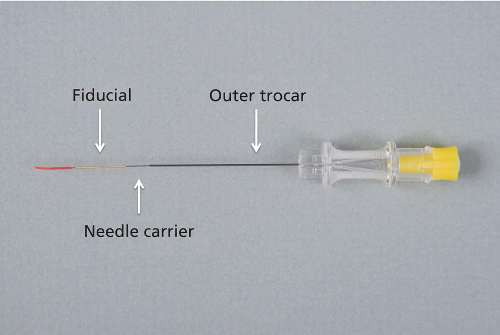 Schematic illustration of gold coil fiducial preloaded on needle-carrier delivery device.