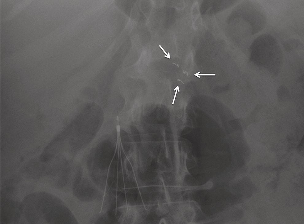 Photo depicts abdominal radiograph (anteroposterior view) demonstrating three fiducials (arrows) located in an adenocarcinoma of the pancreatic head.