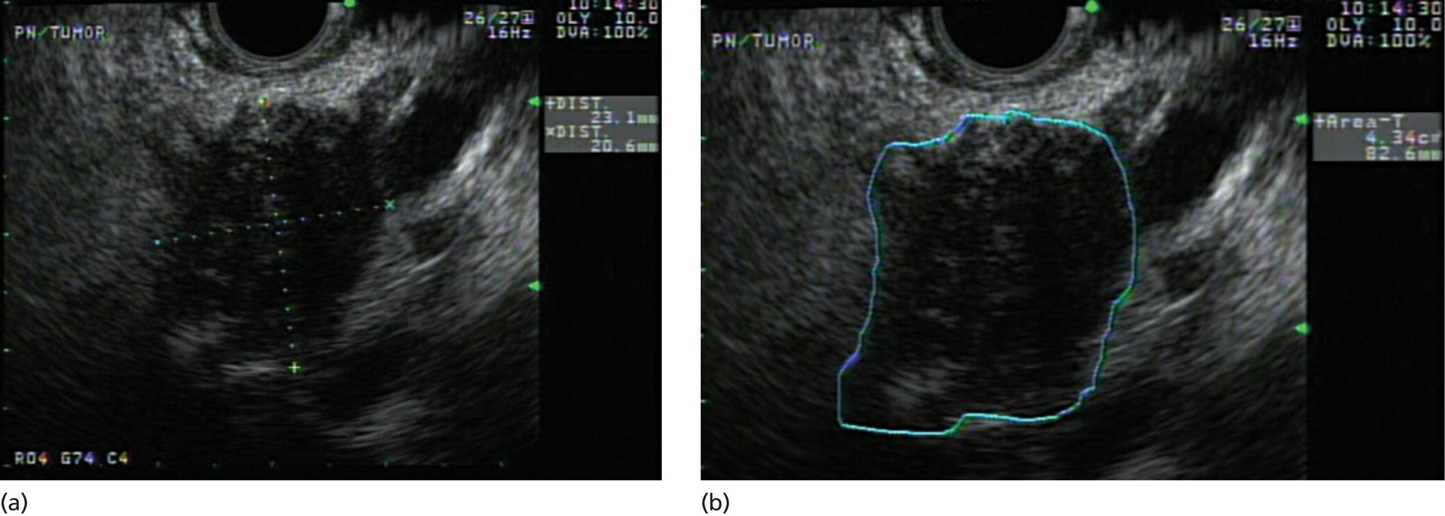 Photos depict initial assessment of tumor size by endoscopic ultrasound (EUS) imaging.