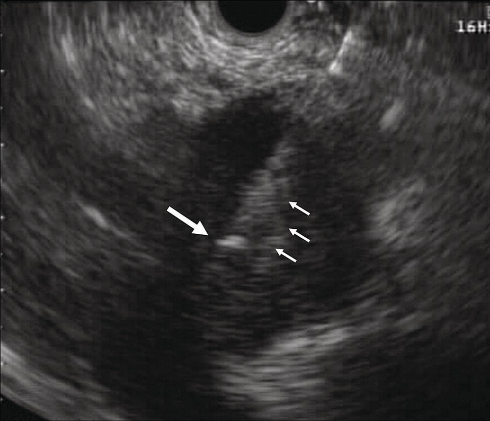 Photo depicts endoscopic ultrasound (EUS)-guided fine needle injection (FNI) of a pancreatic lesion using a 22-gauge needle.