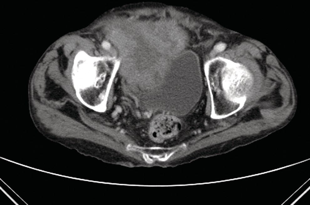 Photo depicts computed tomography (CT) scan of the pelvis revealing an 8 × 7 cm abscess cavity.