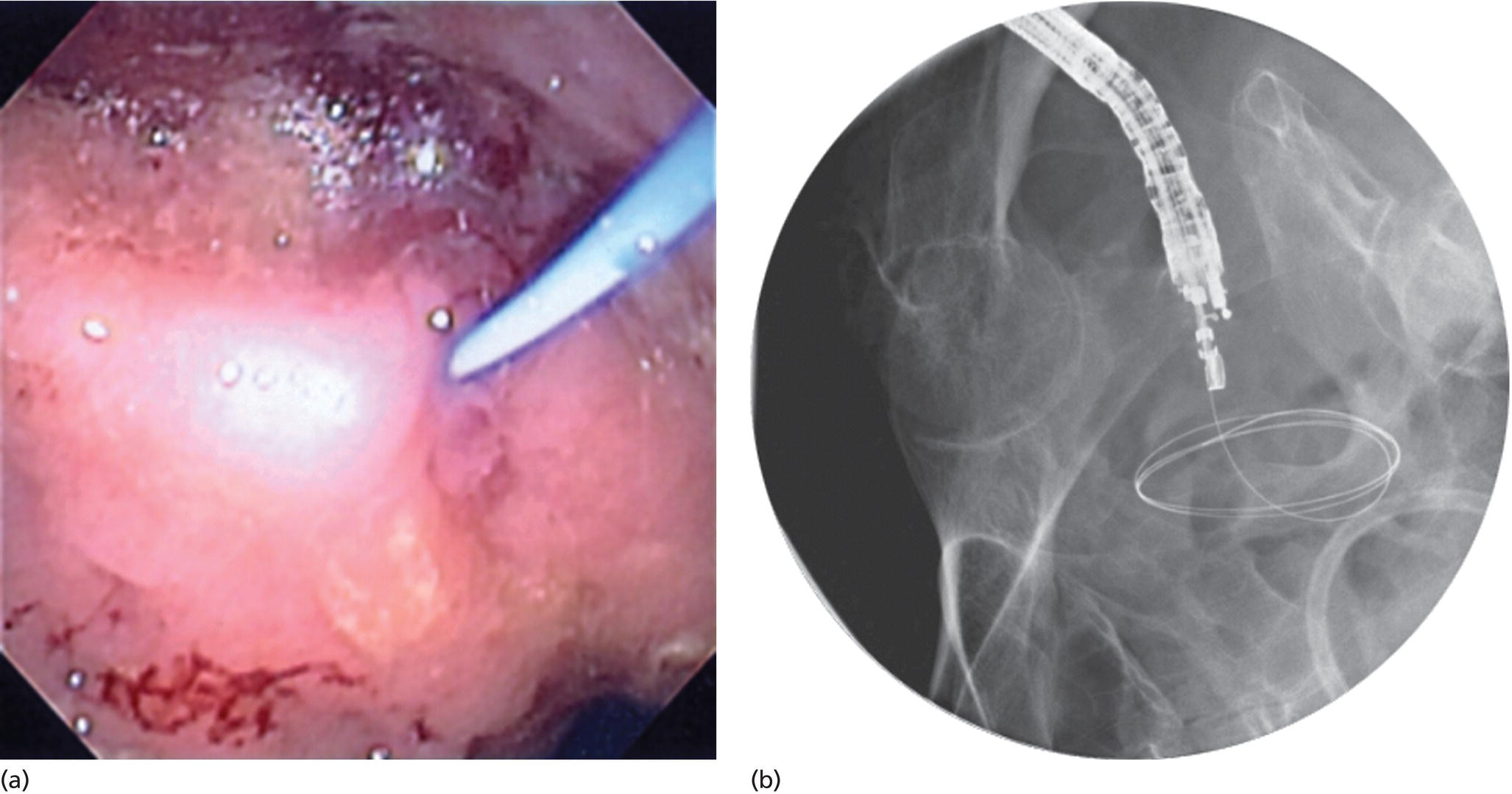 Photos depict a 0.035-inch guidewire is then coiled within the abscess cavity: (a) endoscopy view; (b) confirmed by fluoroscopy.