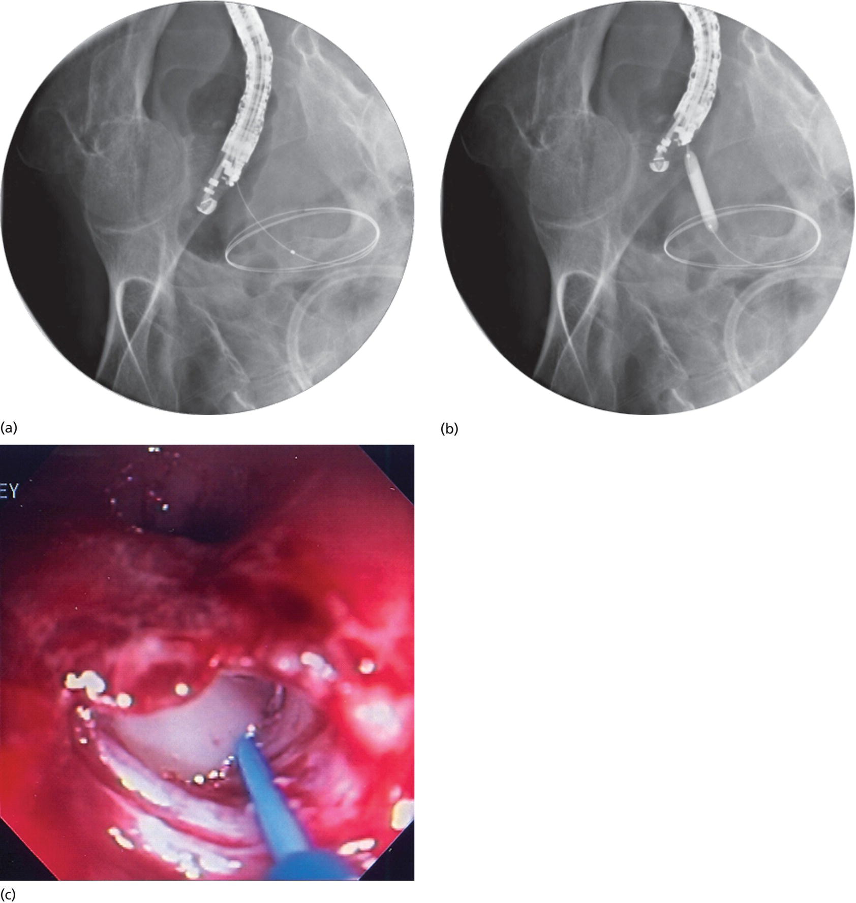 Photos depict fluoroscopy view revealing dilation of the tract using an endoscopic retrograde cholangiopancreatography (ERCP) cannula (a) and then an over-the-wire balloon dilator (b). Pus is seen to extrude following dilation of the transmural tract (c).