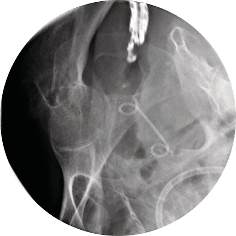 Photo depicts fluoroscopic view revealing the presence of a stent within the pelvic abscess cavity.