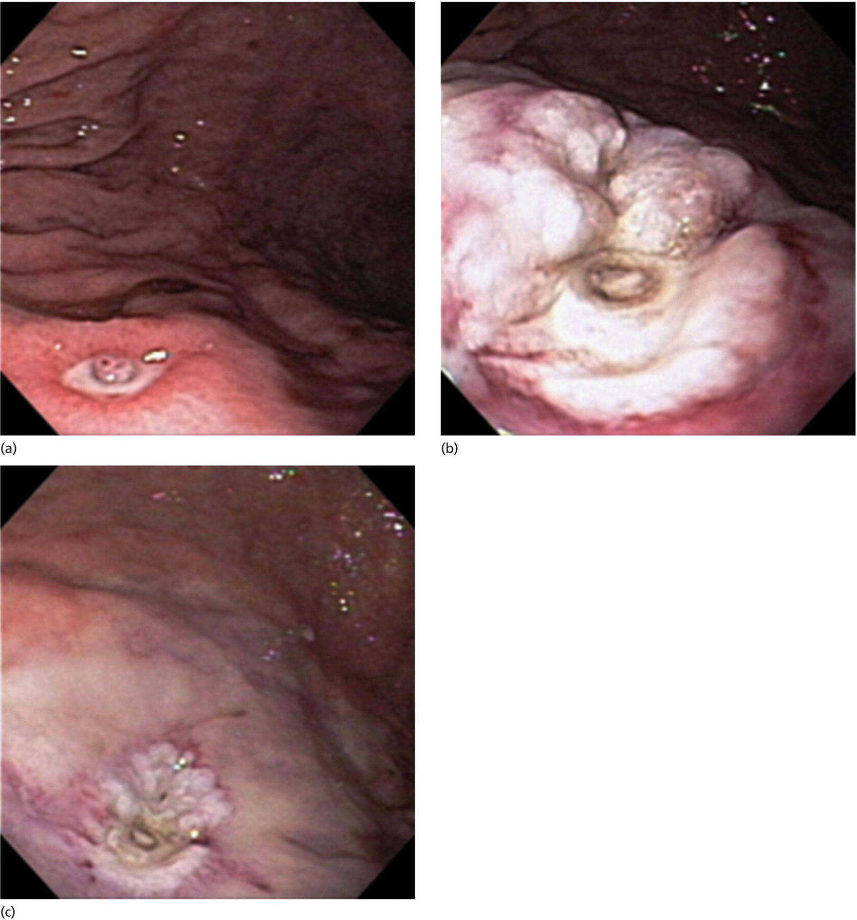 Photos depict doppler ultrasound-guided hemostasis in acute peptic ulcer bleeding.