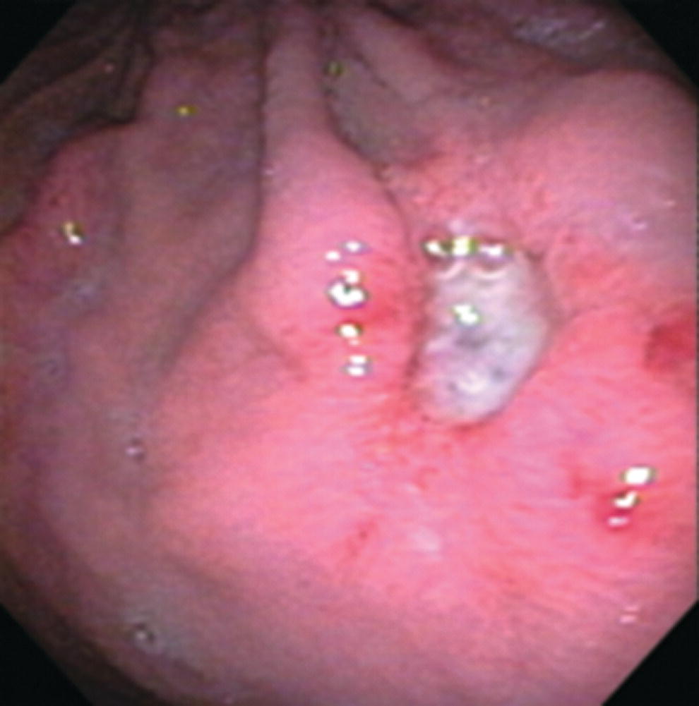 Photo depicts atypical peptic ulcer bleeding: recurrent major bleeding from a gastric ulcer, clean base, without stigmata of recent hemorrhage.