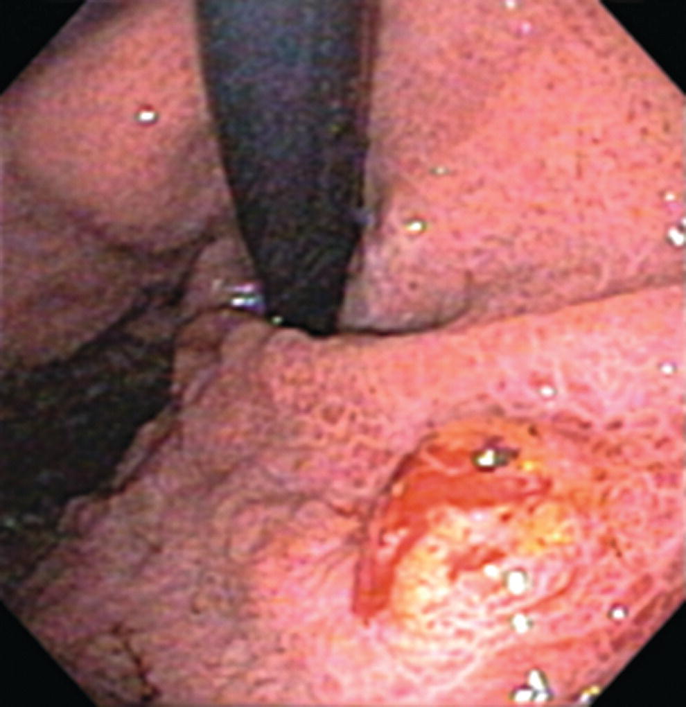 Photo depicts atypical appearance of a bleeding gastric varix.
