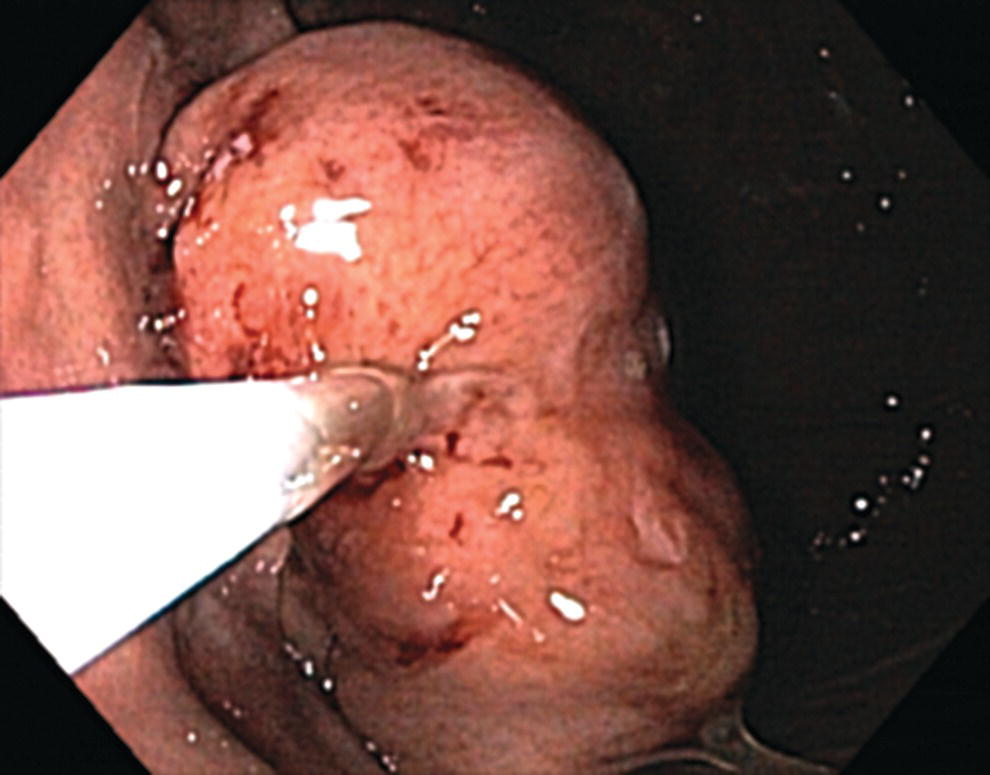Photo depicts doppler ultrasound examination of a gastrointestinal stromal tumor in the gastric fundus, Doppler negative.
