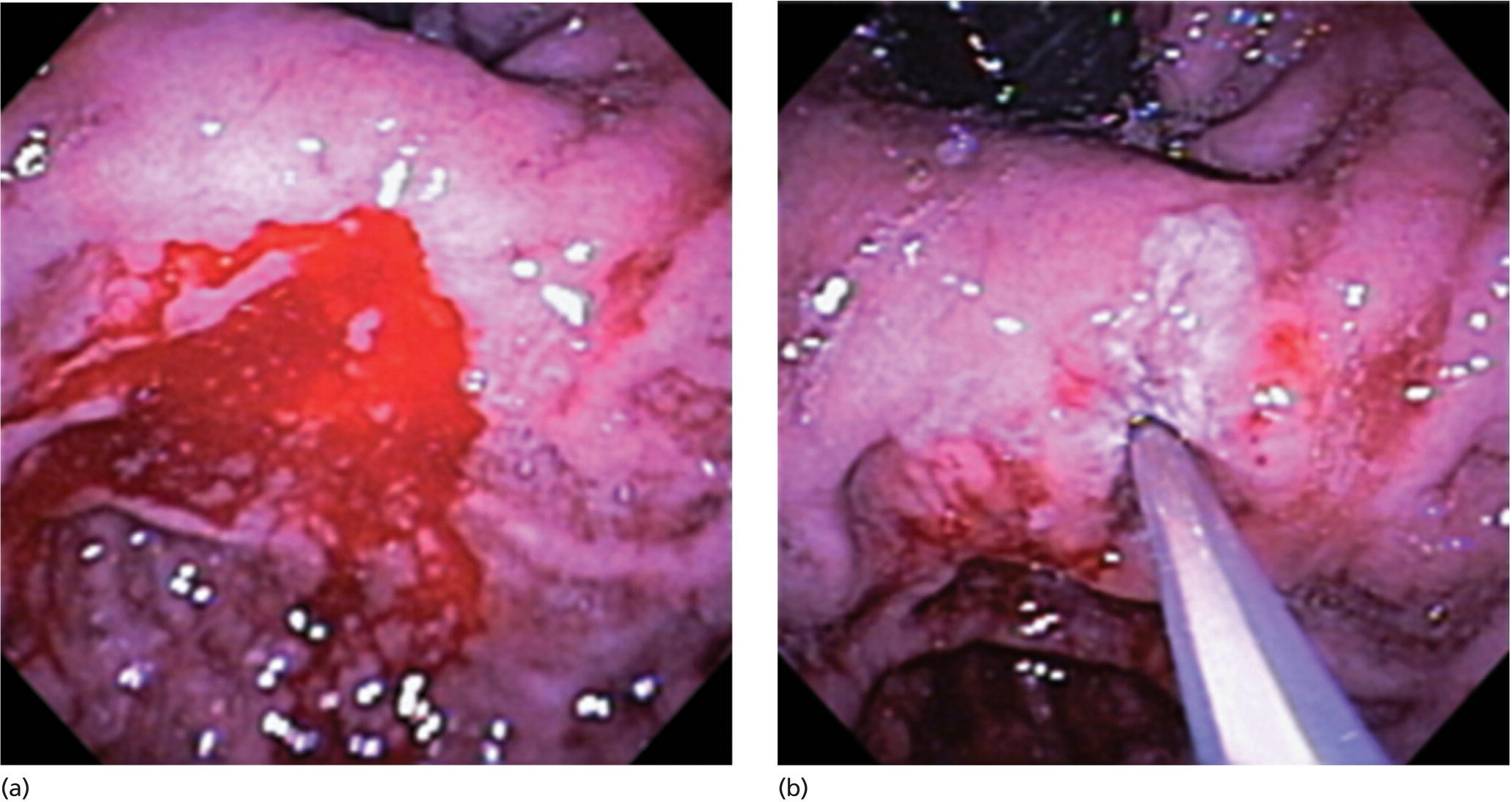 Photos depict dieulafoy lesion in gastric cardia.