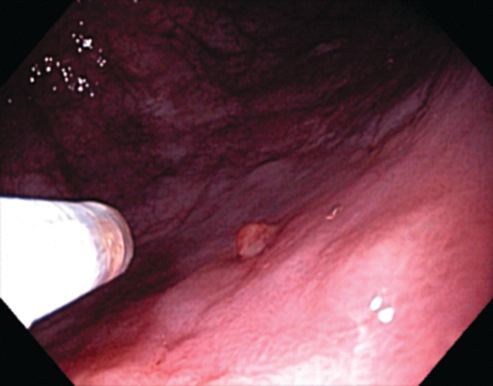 Photo depicts dieulafoy lesion in rectum, Doppler with strong arterial signal.