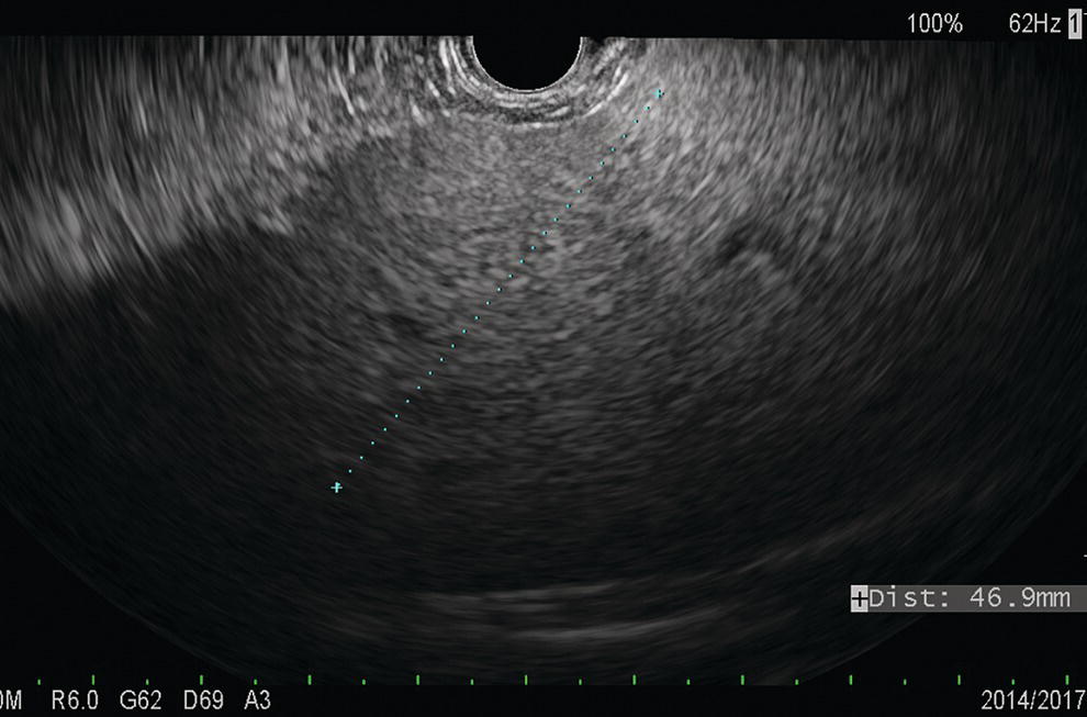 Photo depicts visualization of the left hepatic lobe from the proximal stomach. The cursor shows the expected trajectory of the biopsy needle when obtaining the core specimen.
