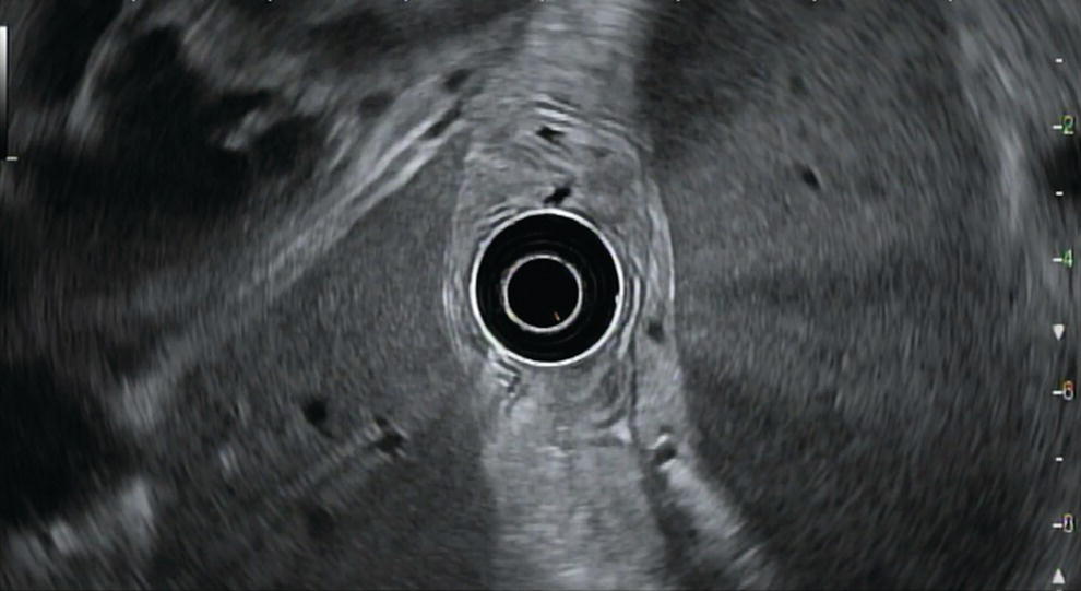 Photo depicts view of liver (on the left) and spleen (on the right) from the proximal stomach with the radial echoendoscope.