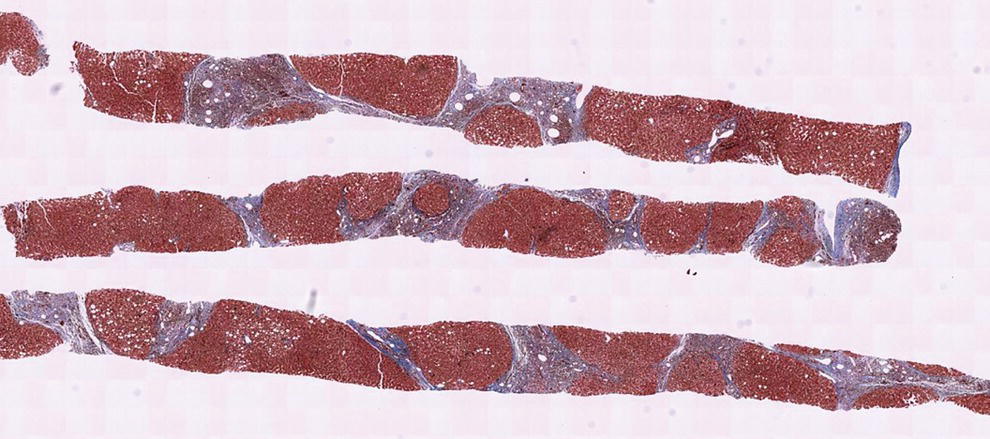 Photo depicts excellent core of cirrhotic liver obtained with the 19G FNB needle.