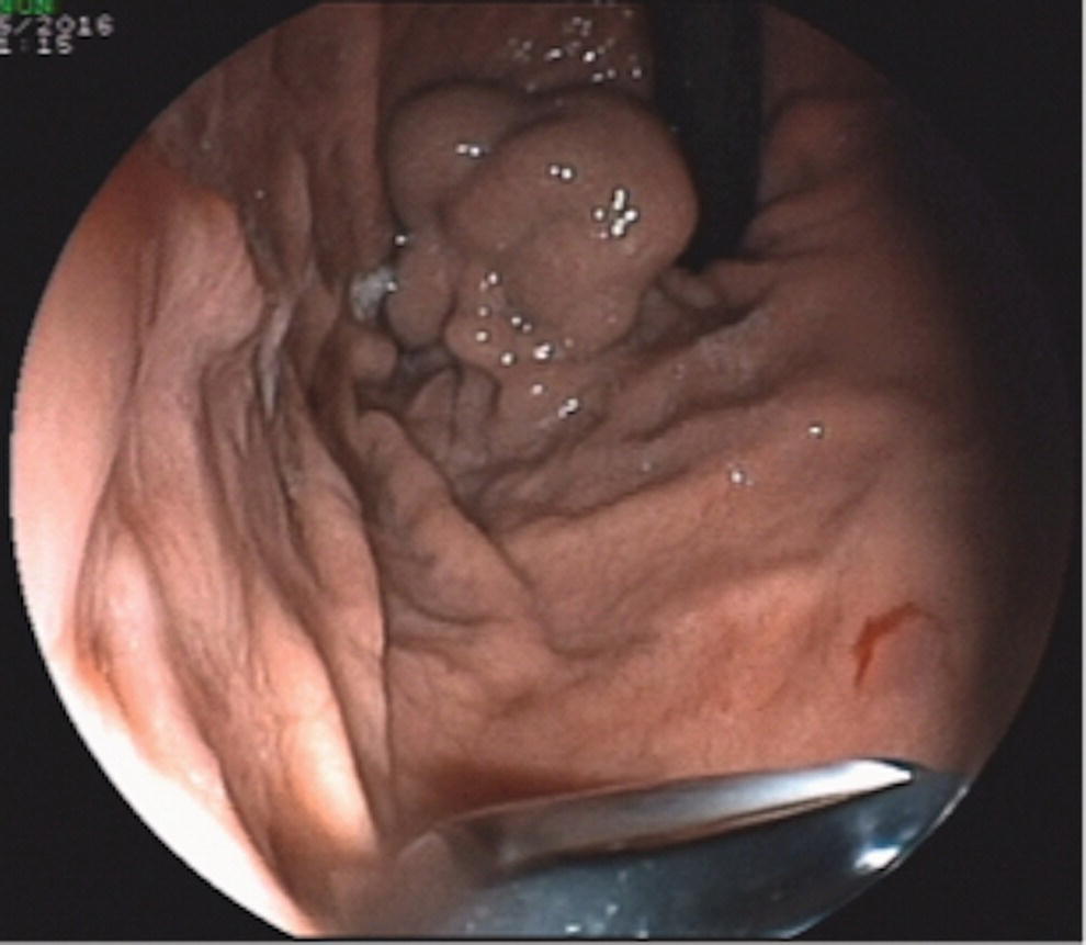 Photo depicts endoscopic imaging of gastric varix.