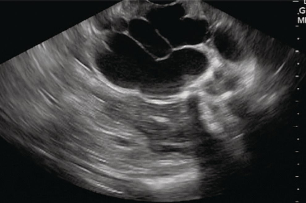 Photo depicts gastric varix seen by endoscopic ultrasonography.