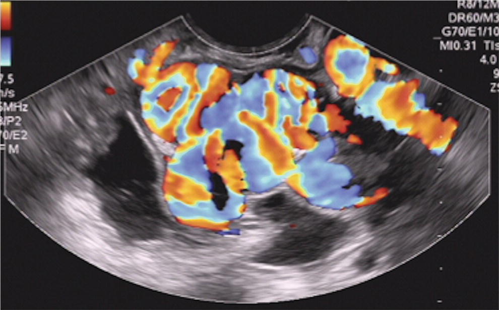 Photo depicts gastric varix seen with color Doppler.