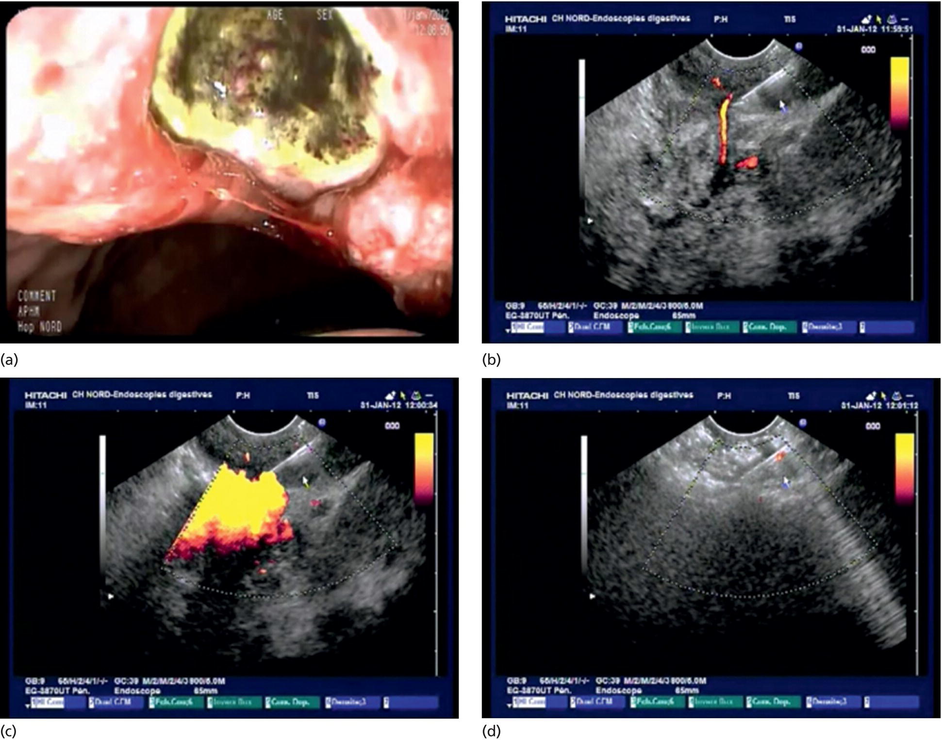 Photos depict patient 1 with refractory bleeding due to gastric cancer.