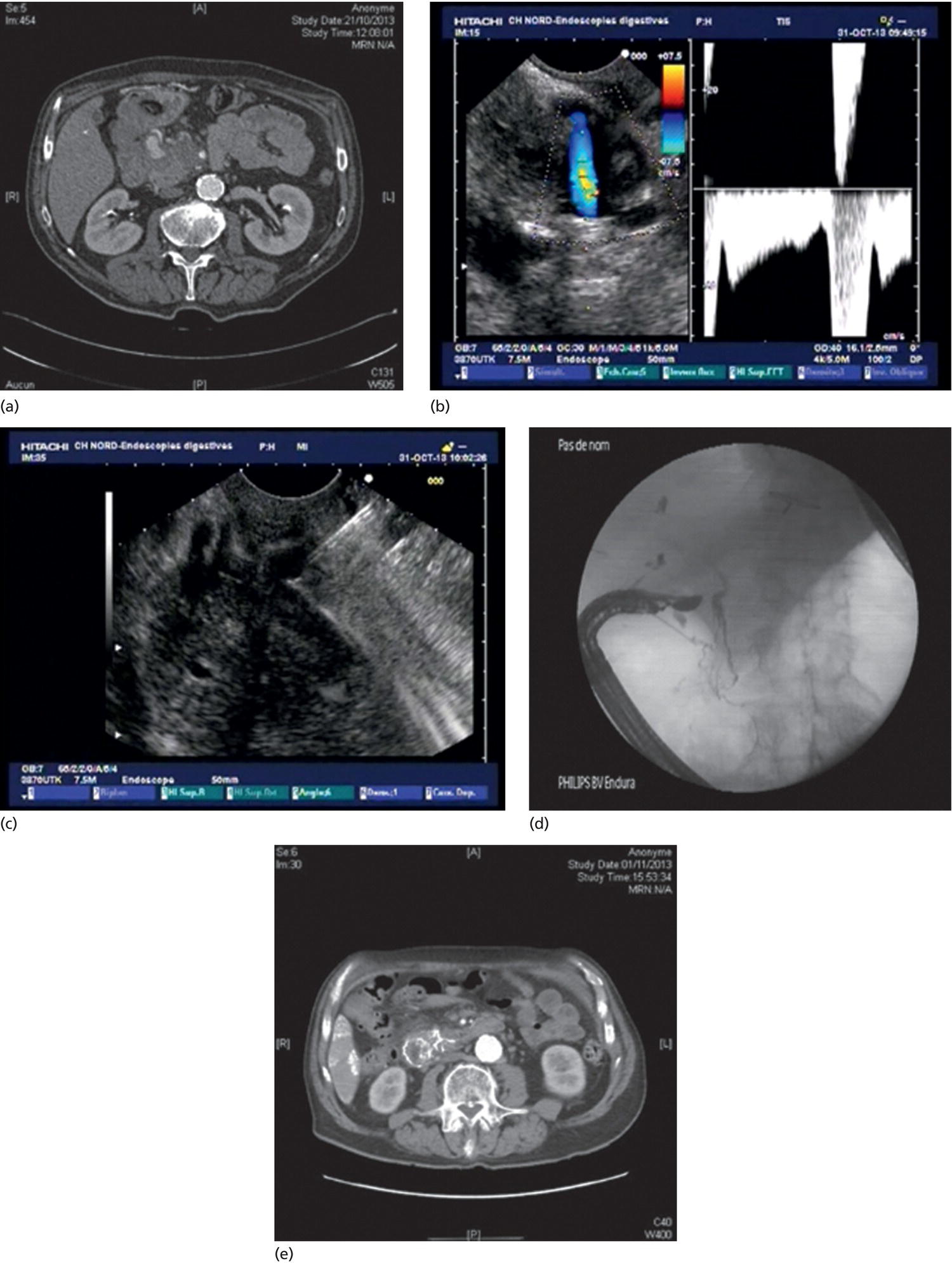 Photos depict patient 2 with bleeding pseudoaneurysm located to the pancreatic head.