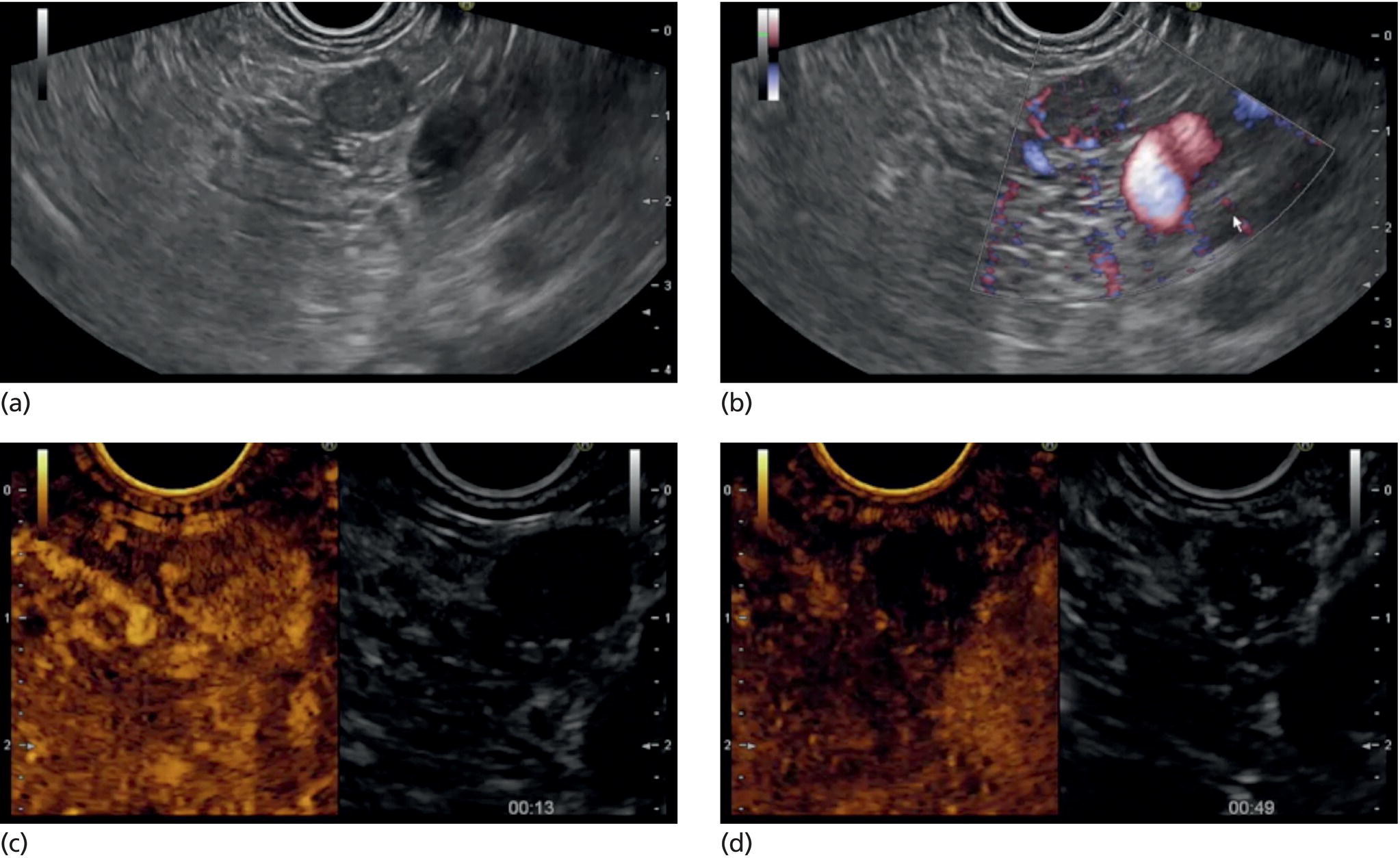 Photo depicts EUS-guided RFA with contrast enhancement control for NET located in the body of the pancreas.